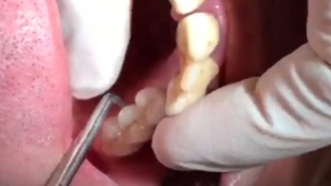 Levacorone — dépose de couronne avec le Magnetic Mallet — seconde démonstration