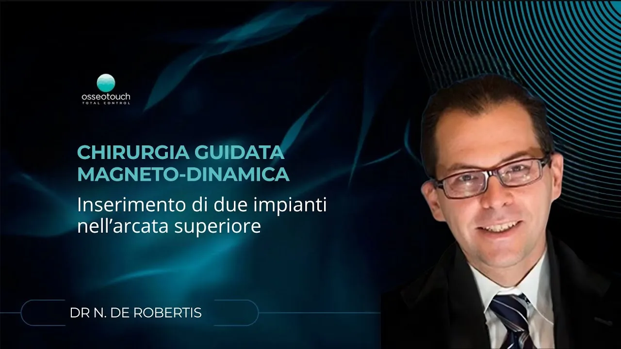 Dr. De Robertis - Due impianti arcata superiore con chirurgia guidata magnetodinamica