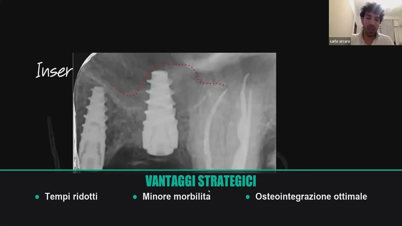 Webinar Dr. Arcara — Sinus Lift e Carico Immediato