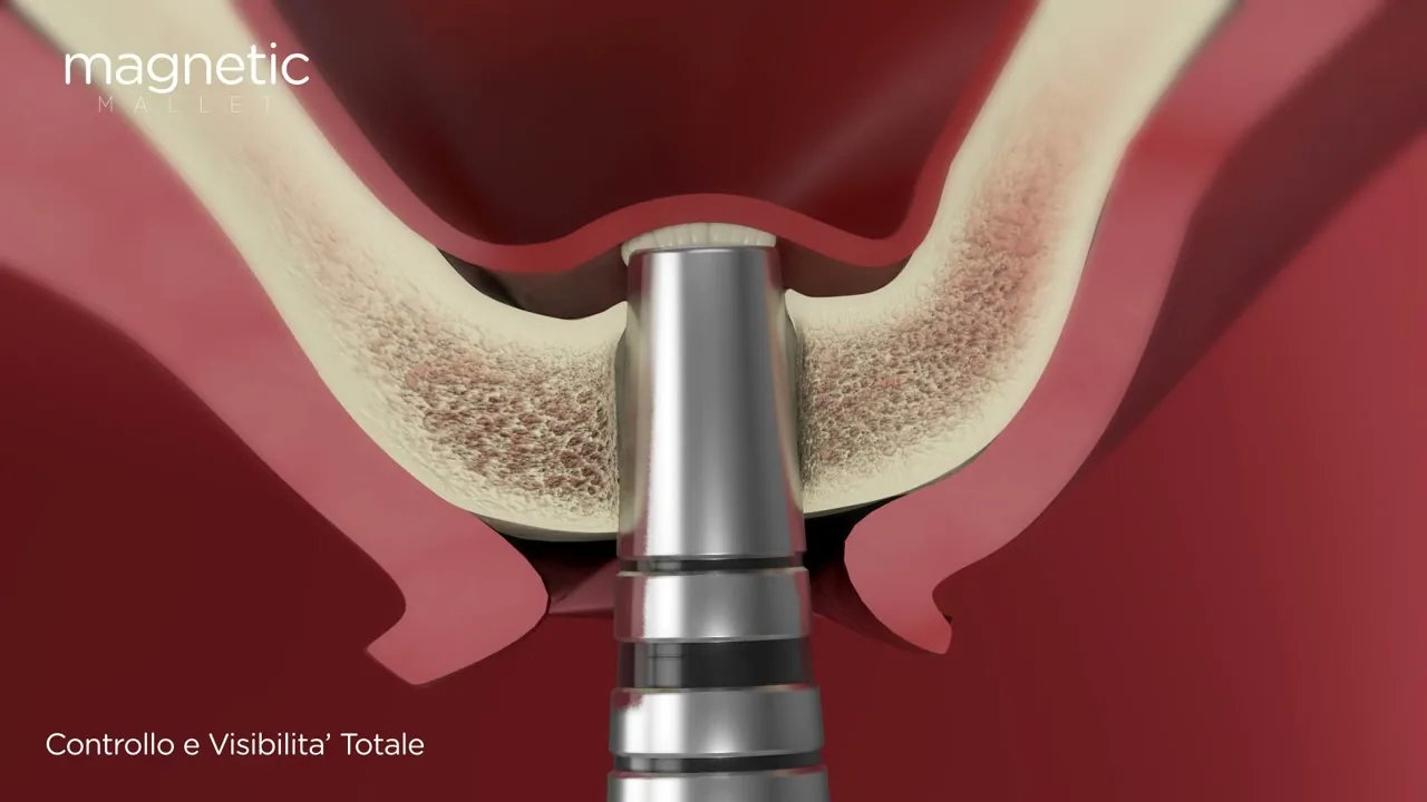 Kit Osteotomi Silver — Video dimostrativo