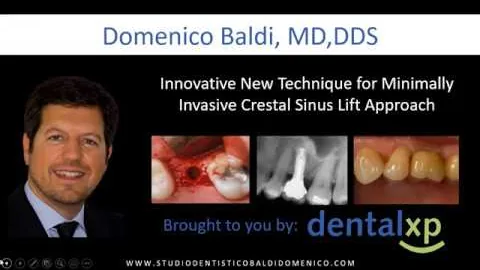 Webinar Dr. Baldi — Sinus lift with Magnetic Mallet