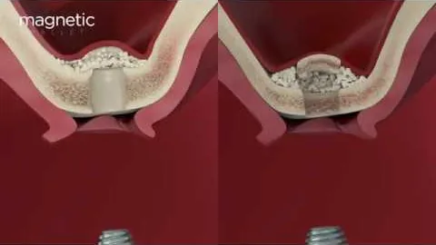 Animazione 3D - Kit Elevate OSSEOTOUCH